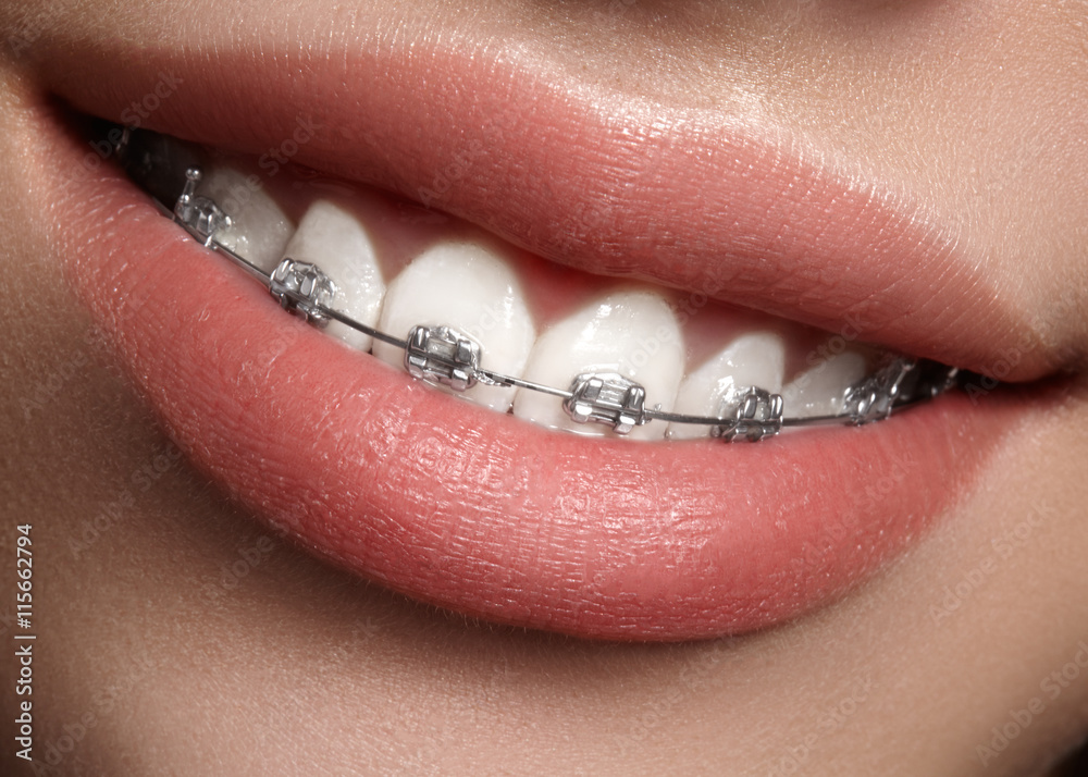 Beautiful macro shot of white teeth with braces. Dental care photo. Beauty woman smile with ortodontic accessories. Orthodontics treatment. Closeup of healthy female mouth

