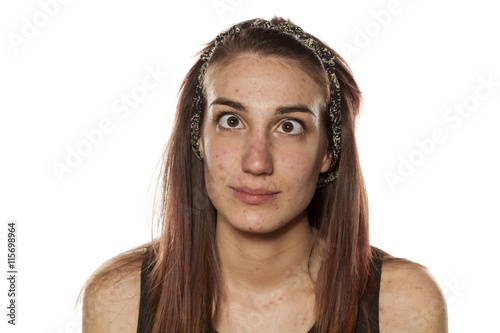 young girl with pimples and crossed eyes photo