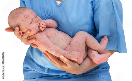 Doctor holding a newborn baby which is sick rubella photo
