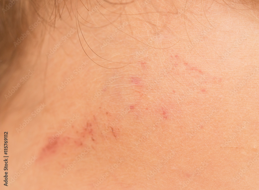 Fototapeta premium abrasion on the skin