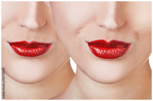 Red lips before and after filler injections