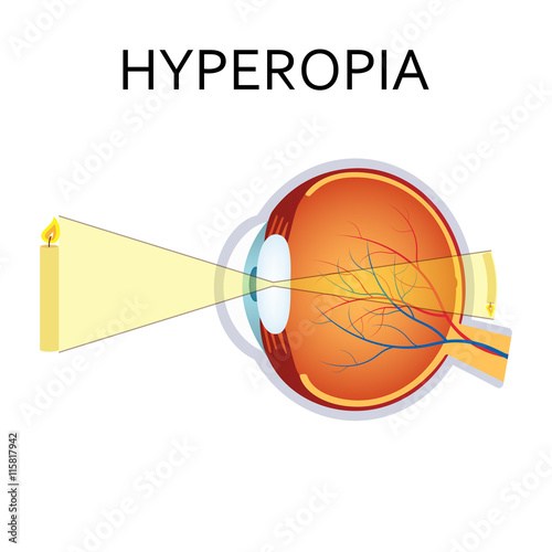 Hyperopia eyesight disorder.