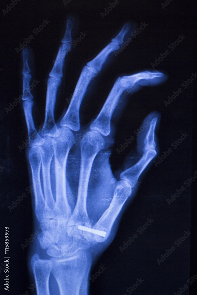 Hand injury fingers xray scan Hand injury fingers xray scan