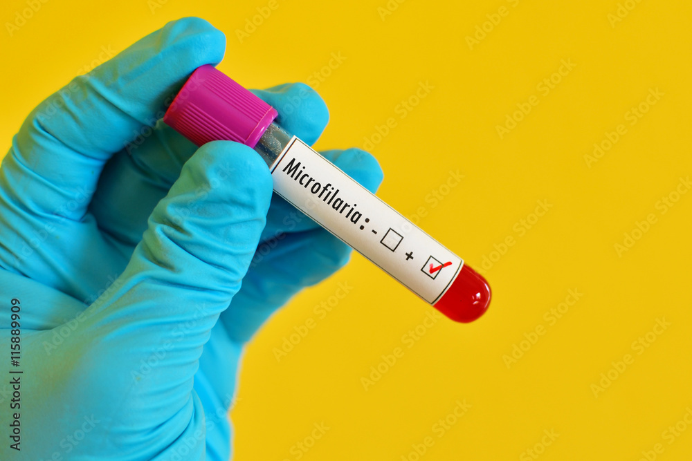 Obraz premium Blood sample positive with Microfilaria parasite (roundworms)