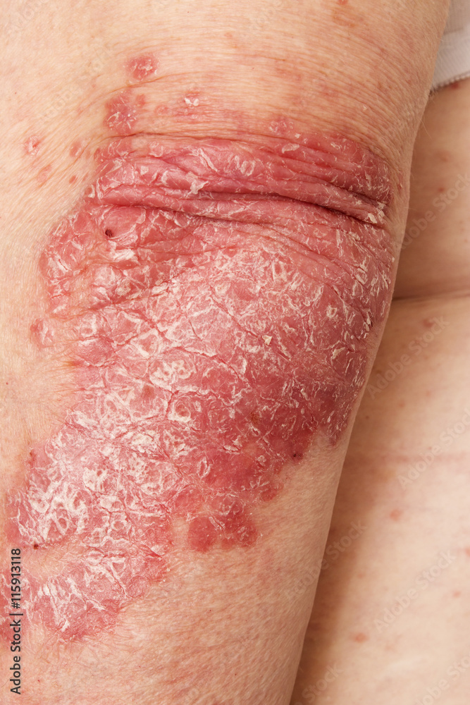 Fototapeta premium Psoriasis, psoriatic skin disease
