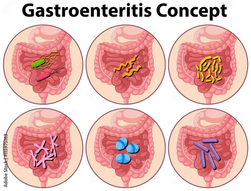 Diagram showing gastroenteritis concept Diagram showing gastroenteritis concept
