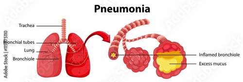 Diagram showing lung with pneumonia