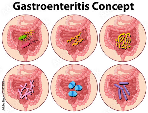 Diagram showing gastroenteritis concept