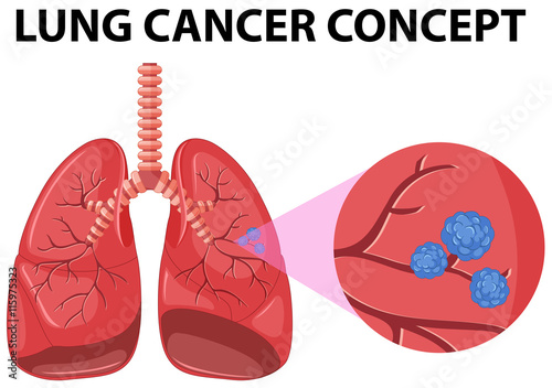 Diagram of lung cancer concept