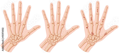 Human hands with bone fracture