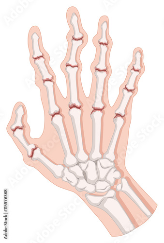 Rheumatoid arthritis in human hand