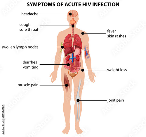 Diagram showing symptoms of acute HIV infection