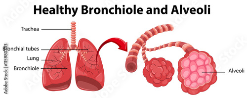 Diagram showing healthy bronchiole and alveoli