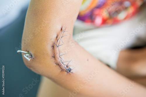 fractured elbow with metal fixators