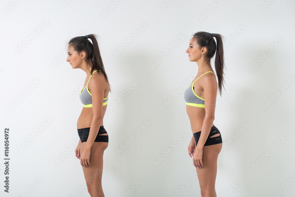 Woman with impaired posture position defect scoliosis and ideal bearing - obrazy, fototapety, plakaty 