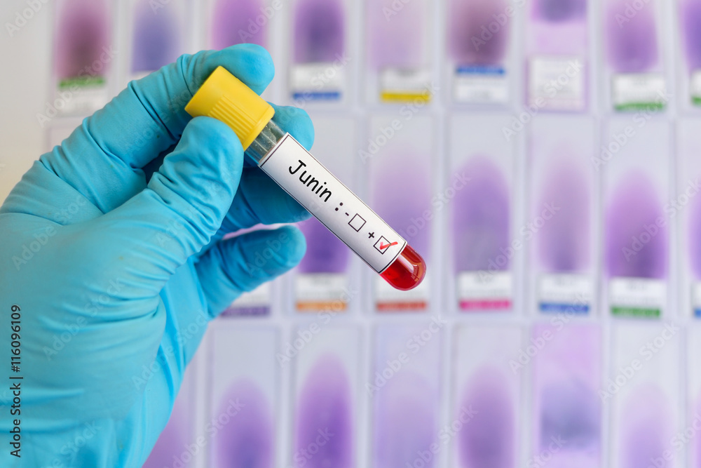 Blood sample positive with Junin virus
Blood sample positive with Junin virus