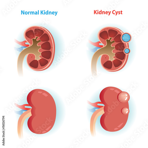 kidney Cyst/kidney Cyst disease and  Normal kidney.Vector illustrations