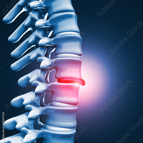 Herniated disk human spinal photo