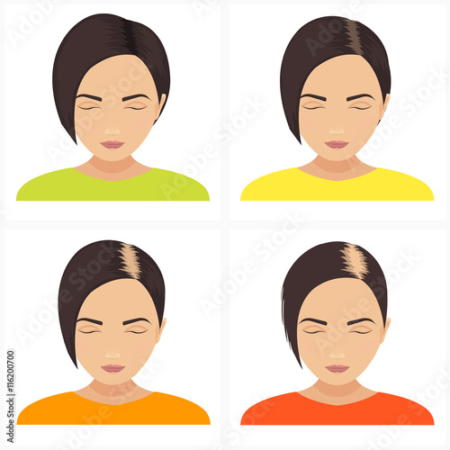 Female hair loss stages vector set. Female pattern baldness. Hair care concept.

