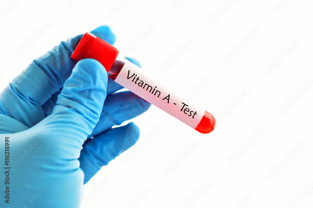 Obraz premium Test tube with blood sample for vitamin A test 