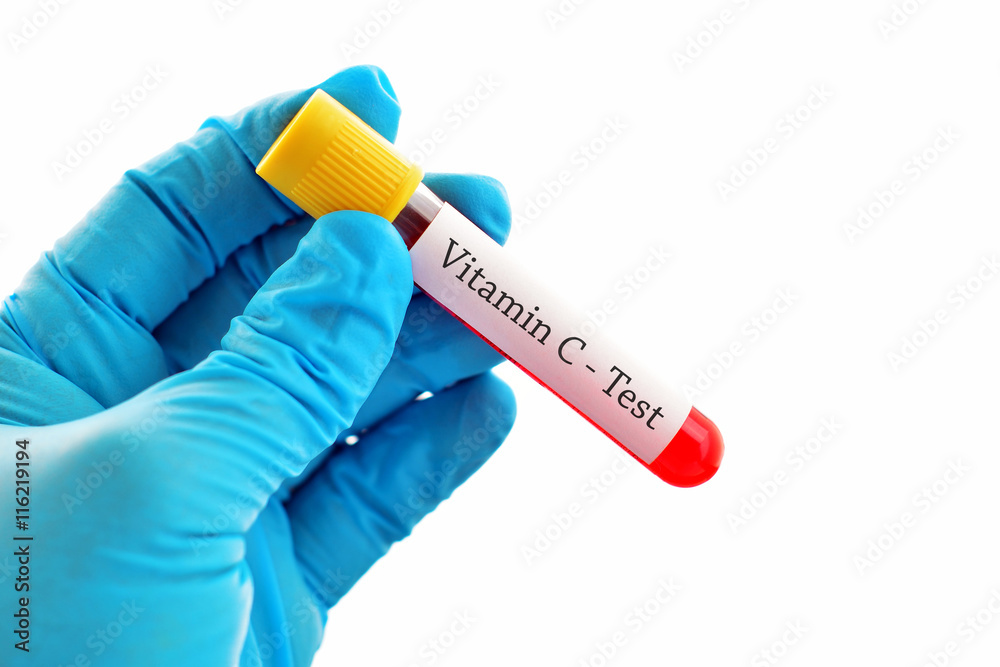 Obraz premium Test tube with blood sample for vitamin C test 