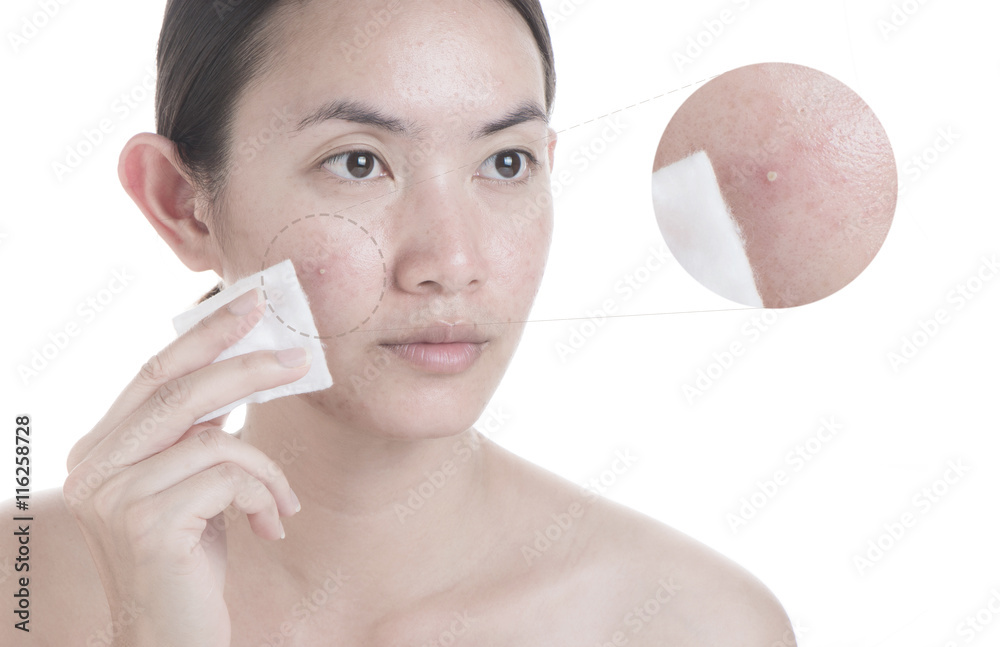 Acne face skin with cotton bud try embrocate to spot. Stock Photo
