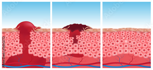 wound skin vector graphic . blood come out of wound  photo