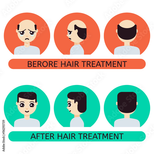 Front, side, back view of a man with hair loss problem before and after hair treatment and hair transplantation. Male hair loss set in cartoon style. Perfect for hair clinics. Vector illustration.