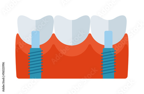 Tooth implant vector illustration. Tooth implant vector isolated on white background. Tooth implant vector icon illustration. Tooth implant vector isolated vector