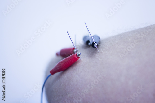 Electroacupunture acupunture needles photo