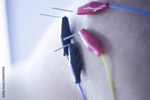 Electroacupunture acupunture needles photo