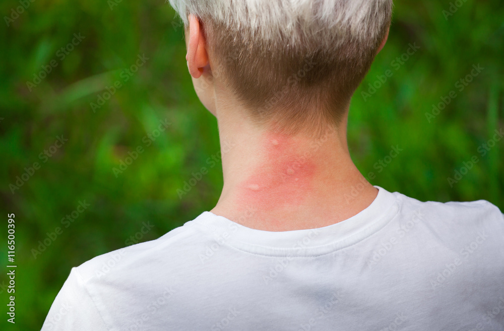 mosquito bites.Girl with blond hair,sitting with his back turned and scratching bitten,red neck skin from mosquito bites in the summer in the forest.Close-up of visible insect bites.Irritated skin mosquito bites.Girl with blond hair,sitting with his back turned and scratching bitten,red neck skin from mosquito bites in the summer in the forest.Close-up of visible insect bites.Irritated skin