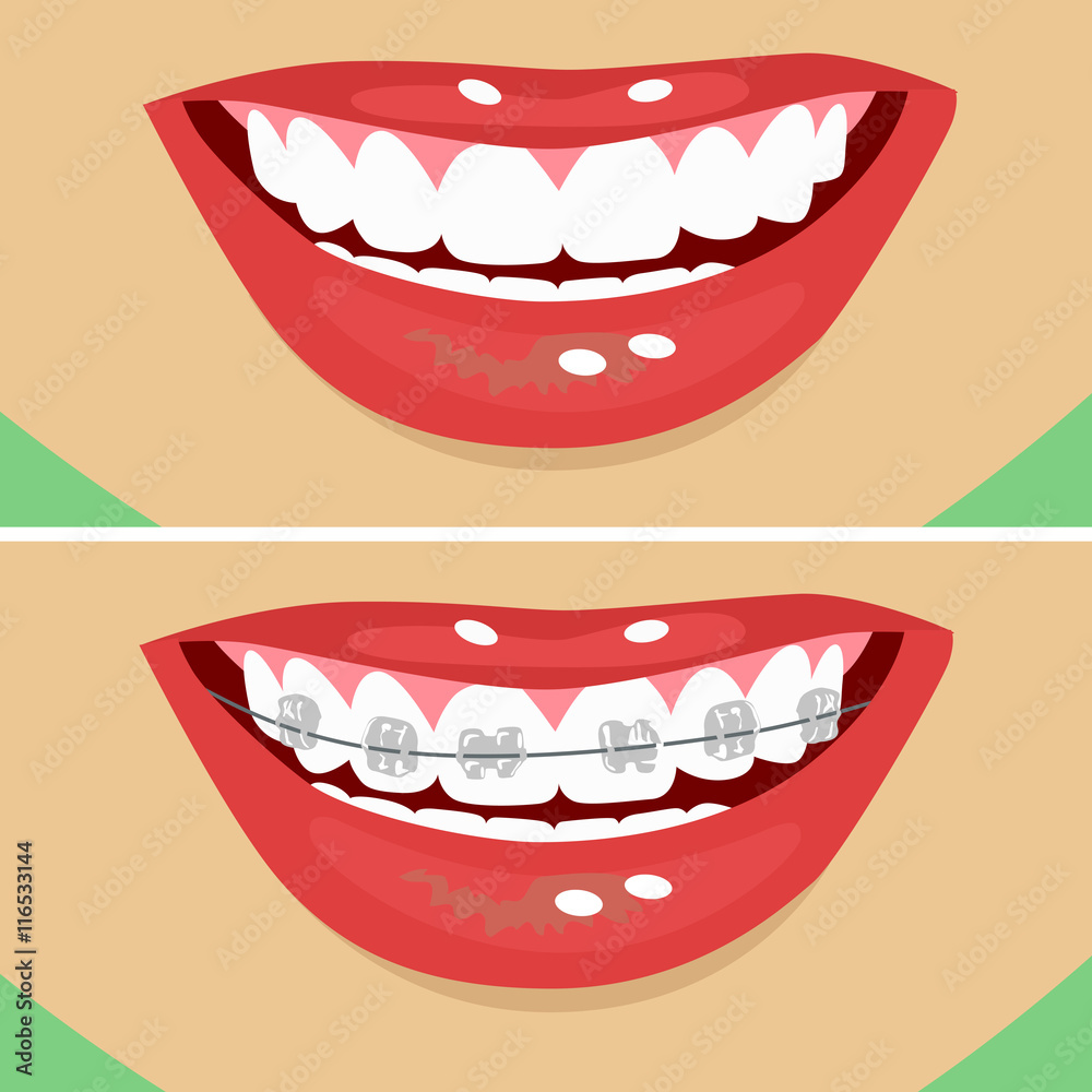 dental braces, before and after