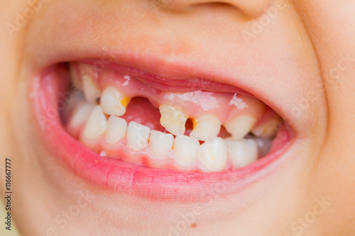 Canvas Print selective focus broken teeth of asian little girl