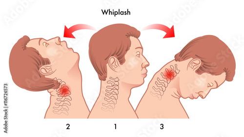 whiplash injury