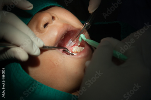 Still Life-Dentists using the tool dental children, sealant.
