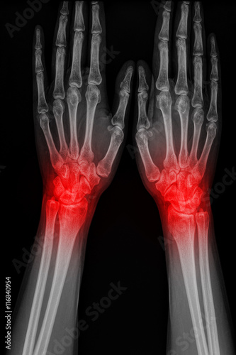 Film x-ray hand of man with arthritis