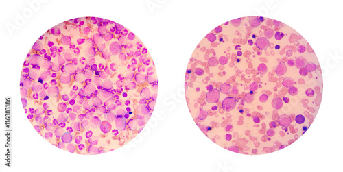 Microscopic views of a blood smear from leukemia cancer patient  photo
