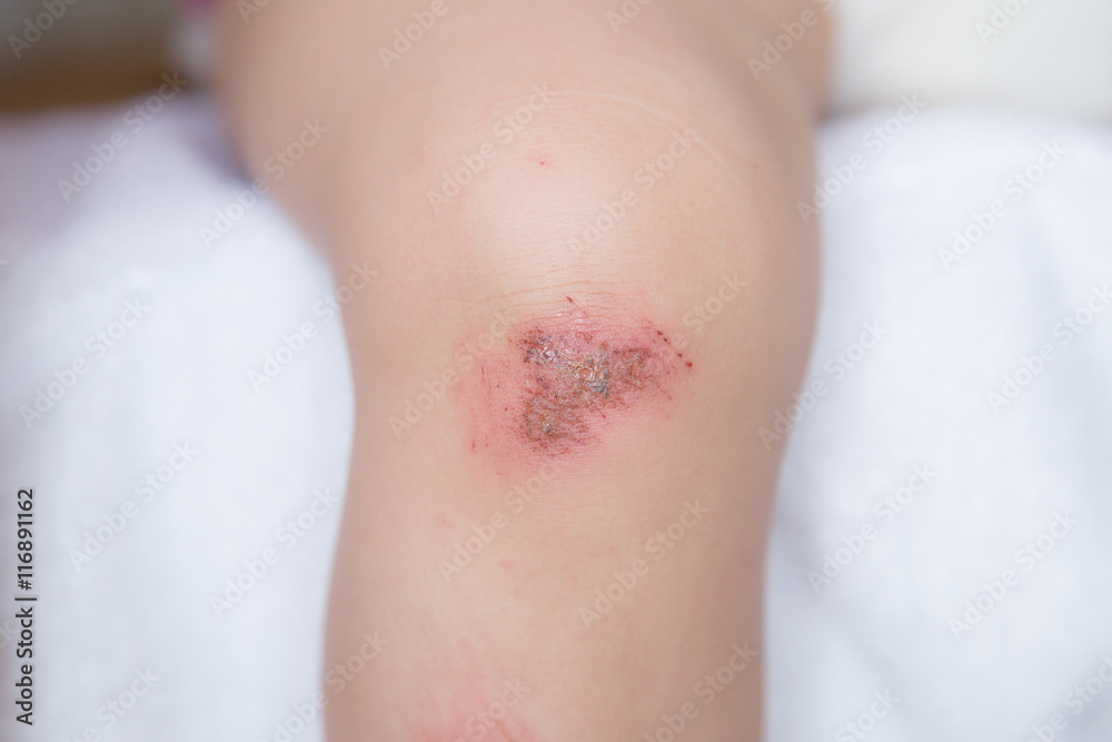 Wunde am Knie eines kleinen Kindes Wunde am Knie eines kleinen Kindes