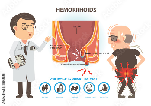 Hemorrhoids/Man ache of hemorrhoids and Doctors to talk to patients. Diagram the anal anatomy. internal and external hemorrhoids 