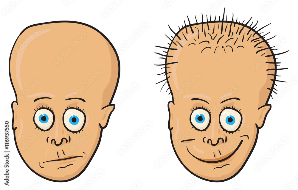 Vector illustration - patient with a bald head and hair Vector illustration - patient with a bald head and hair