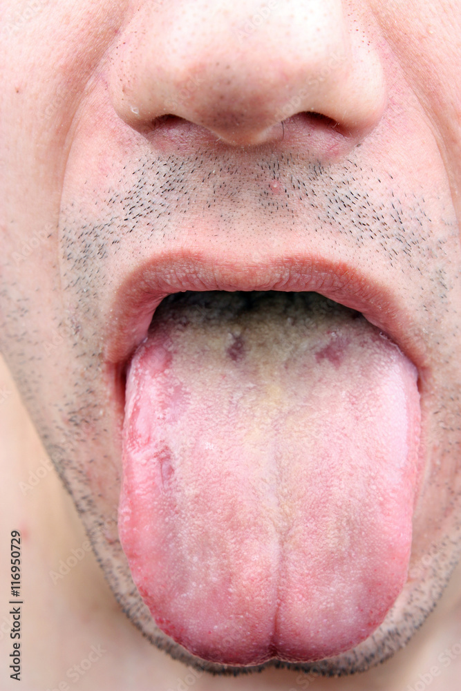 Bacterial Infection Disease Tongue Stock Photo Adobe Stock