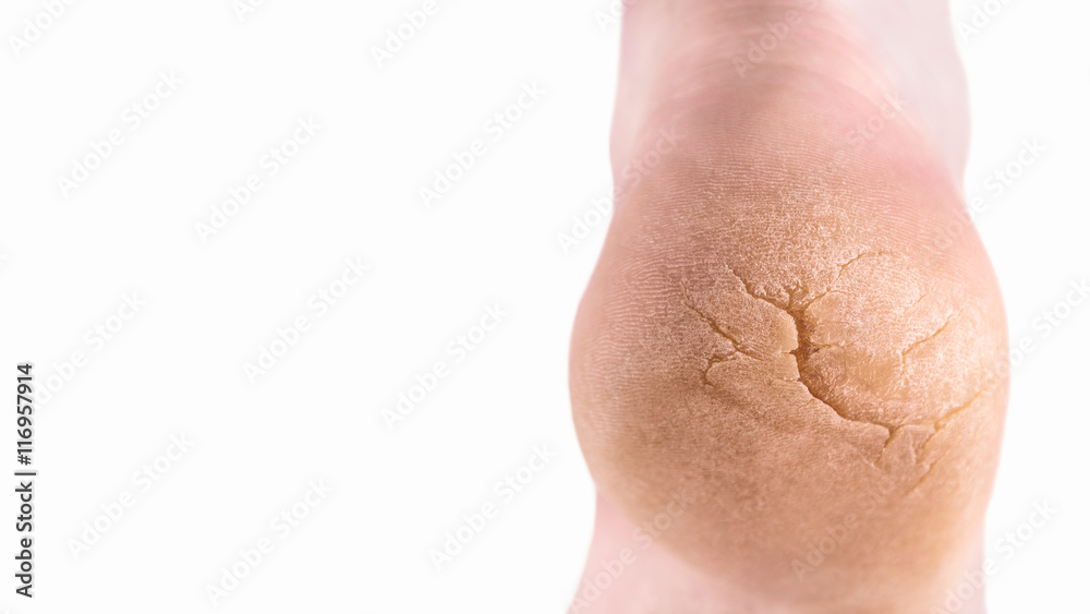 Fototapeta premium Severely cracked heel isolated on white with copy space