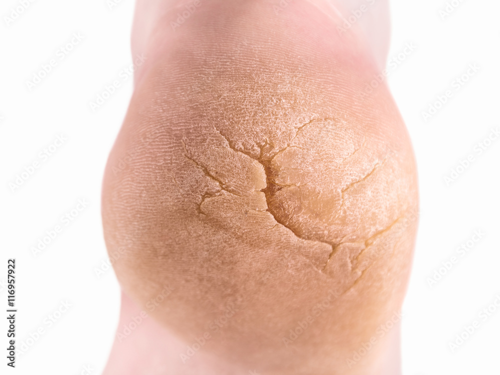 Fototapeta premium Severely cracked heel tight shot isolated on white