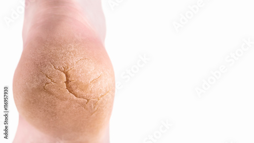 Severely cracked heel isolated on white with copy space