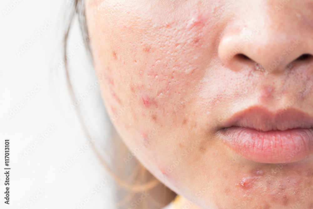 Ταπετσαρία Girl with problematic skin and scars from acne (scar)