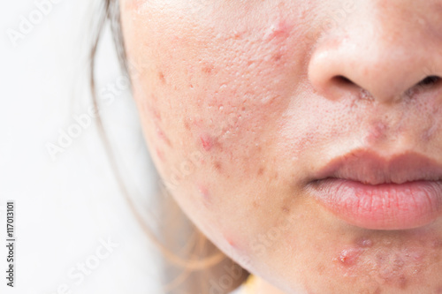 Girl with problematic skin and scars from acne (scar) photo