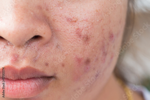 Girl with problematic skin and scars from acne (scar)