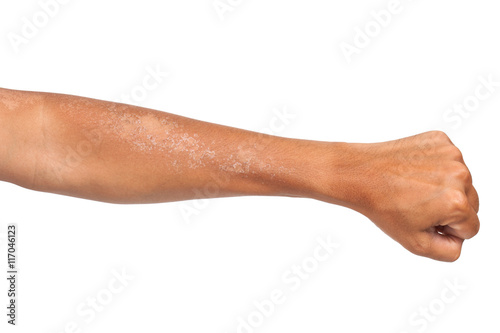 peeling of skin after burned by sunlight