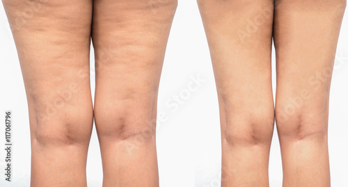 Cellulite  women. Figure of a young girl before and after.